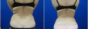 liposuction-7-3