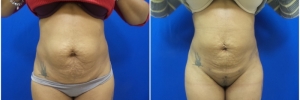 liposuction-8-1