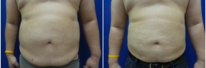 liposuction-9-1