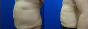 liposuction-9-2