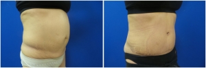 liposuction-abdominoplasty-before-after-photo-20-3