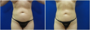 liposuction-before-after-photo-14-1