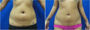 liposuction-before-after-photo-17-1