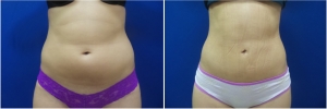 liposuction-before-after-photo-18-1