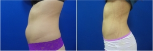 liposuction-before-after-photo-18-2