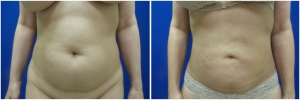 liposuction-before-after-photo-19-1