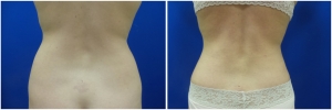 liposuction-before-after-photo-19-2