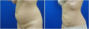 liposuction-before-after-photo-19-3