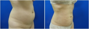 liposuction-before-after-photo-19-4