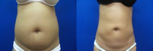 liposuction-before-after-photo-22