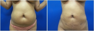 liposuction-fat-transfer-before-after-photo-15-1