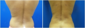 liposuction-fat-transfer-before-after-photo-15-2