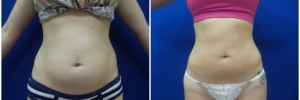 liposuction-fat-transfer1