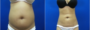 liposuction1-1