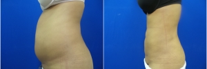 liposuction1-3