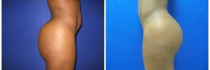 liposuction1