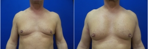 pec-implants-1