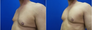 pec-implants-2