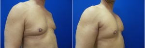 pec-implants-3