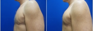 pec-implants-5-1