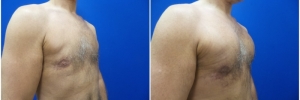 pec-implants-5-2