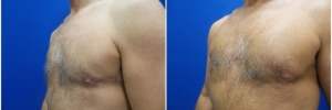 pec-implants-5-3