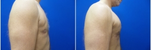 pec-implants-5-4