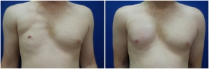 pec-implants-7-1