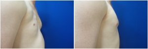 pec-implants-7-2