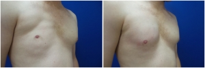 pec-implants-7-3