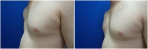 pec-implants-7-4