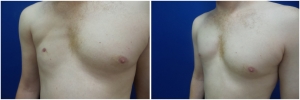 pec-implants-7-5