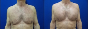pec-implants1-1