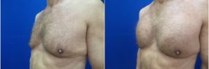pec-implants1-2