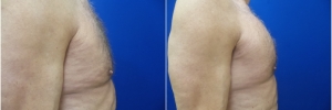 pec-implants1-3