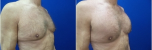 pec-implants1-4