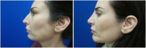 rhinoplasty-before-after-photo-12-1