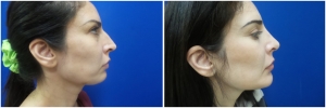 rhinoplasty-before-after-photo-12-3