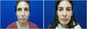 rhinoplasty-before-after-photo-12-4