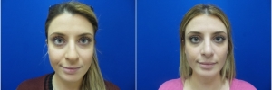 female-rhinoplasty1-1