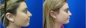 female-rhinoplasty1-2