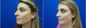female-rhinoplasty1-3