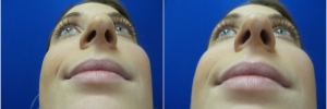 female-rhinoplasty1-4