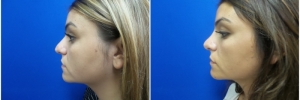 rhinoplasty-5-1