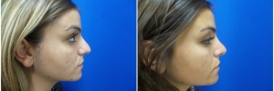rhinoplasty-5-2
