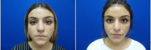 rhinoplasty-5-3