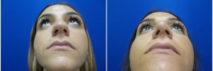 rhinoplasty-5-4
