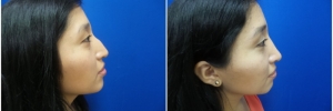 rhinoplasty-6-1