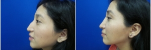 rhinoplasty-6-2