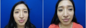rhinoplasty-6-3
